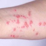 Boston residents encouraged to get mpox vaccine amid uptick in cases