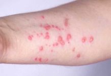 Pride Month Kicks Off With MONKEYPOX OUTBREAK! Boston residents encouraged to get mpox vaccine amid uptick in cases