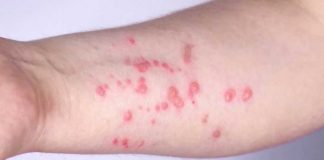 Boston residents encouraged to get mpox vaccine amid uptick in cases